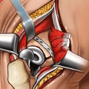 Купить ключ дешево Hip Surgery Simulation (Mobile)